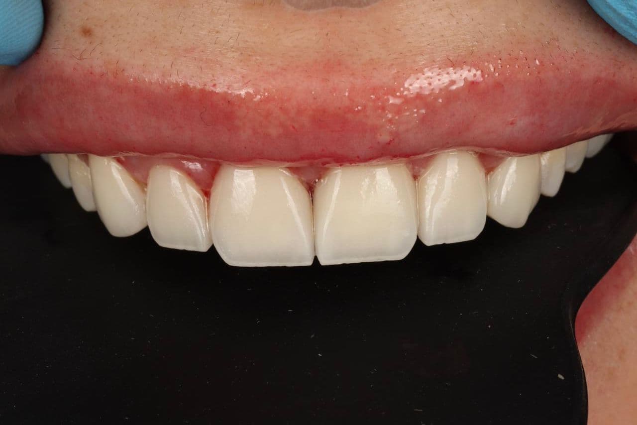 Full Arch Rehabilitation